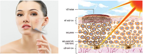 Giúp chị em “Khỏe làn da - Nám tránh xa” 2