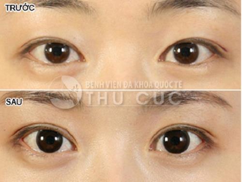 Đẹp trong veo nhờ khắc phục nhược điểm đôi mắt - Ảnh 5.
