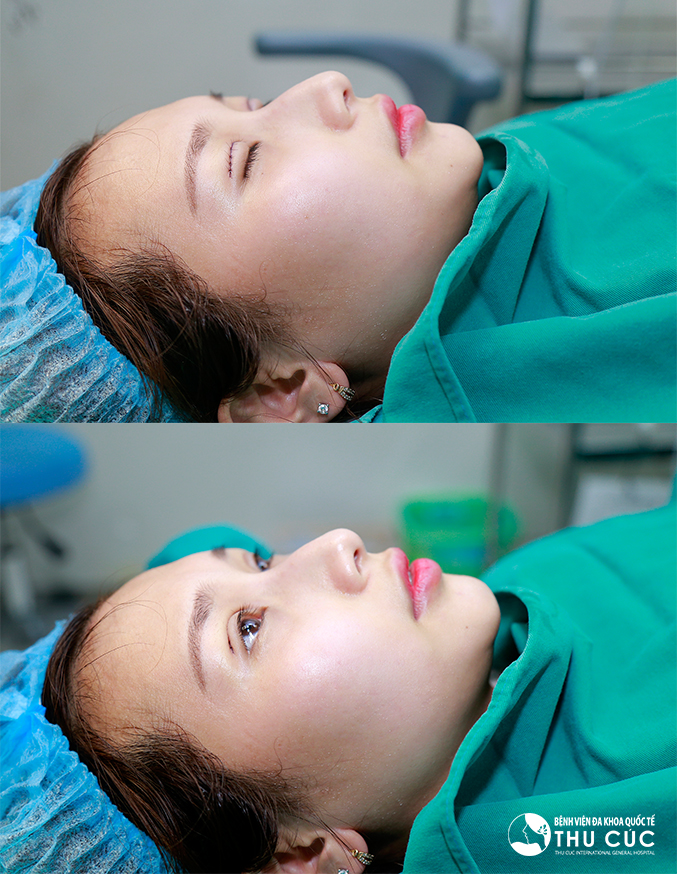 Cắt m&iacute; mắt &ndash; Tiểu phẫu nhỏ nhưng kh&ocirc;ng thể chủ quan - Ảnh 5.