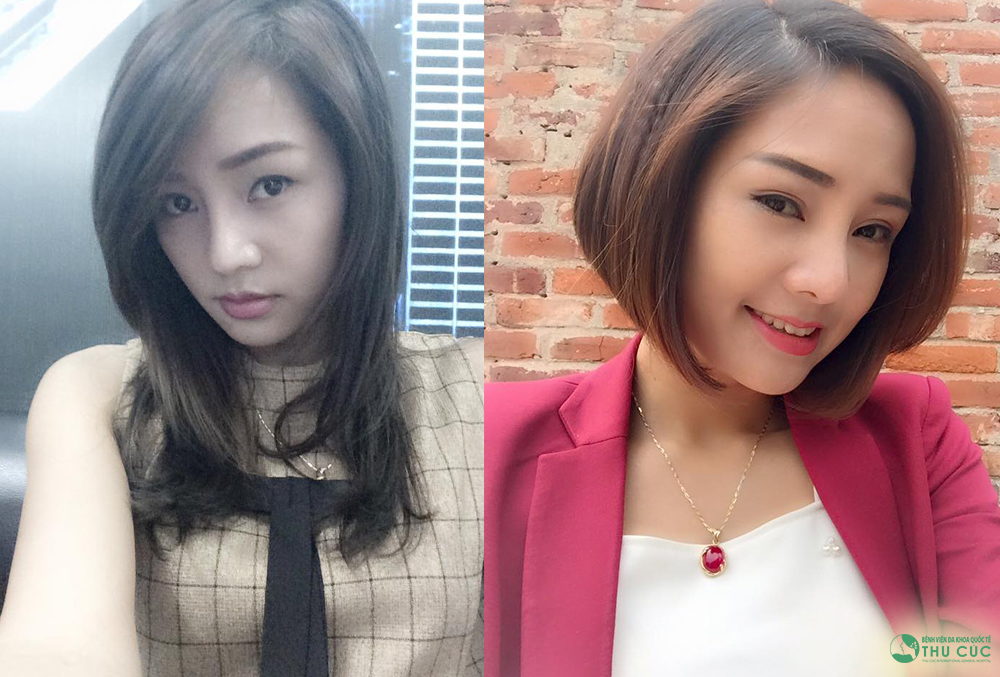 C&ocirc; n&agrave;ng 9X tươi tắn hơn bội phần nhờ phẫu thuật cắt m&iacute; mắt - Ảnh 1.
