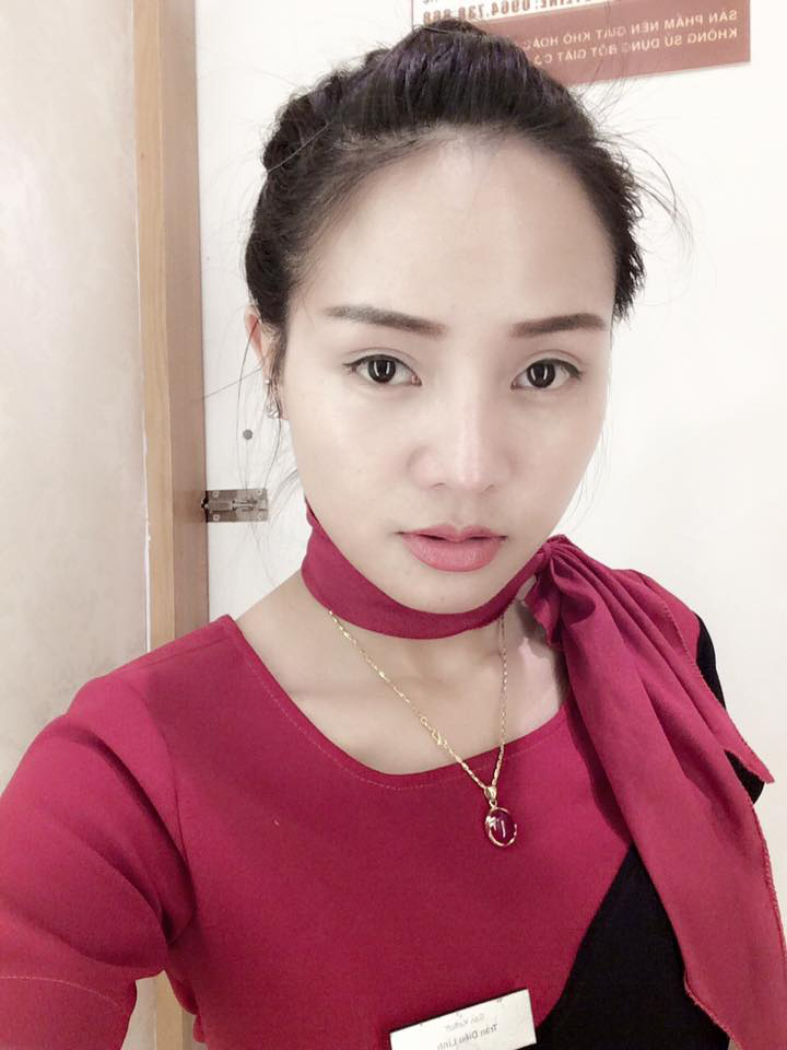 C&ocirc; n&agrave;ng 9X tươi tắn hơn bội phần nhờ phẫu thuật cắt m&iacute; mắt - Ảnh 2.