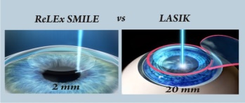 ReLEx SMILE &ndash; Bye bye cặp k&iacute;nh - Ảnh 2.
