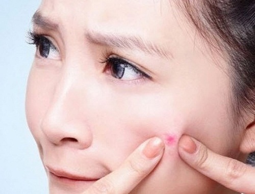 Bí quyết thoát mụn cho các nàng - Ảnh 1.