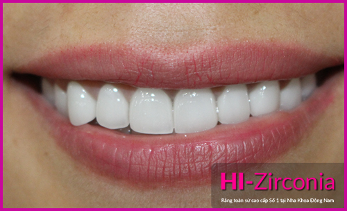 HI–Zirconia – Giải pháp làm răng sứ cao cấp - Ảnh 4.
