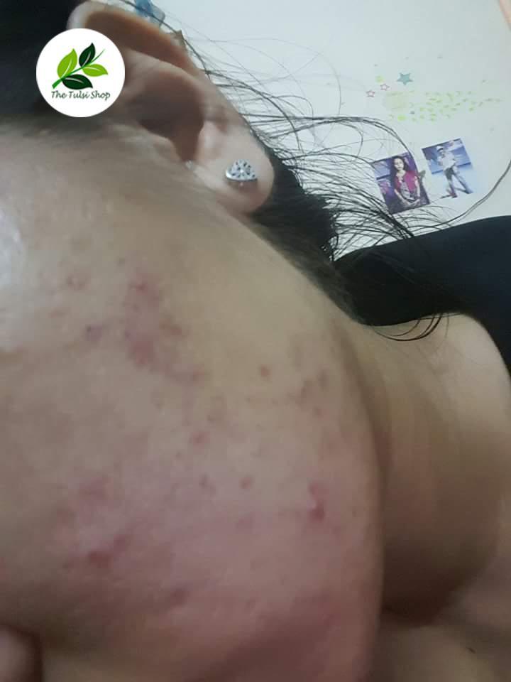 Nhật k&yacute; trị mụn gian nan của c&ocirc; g&aacute;i 24 tuổi - Ảnh 1.