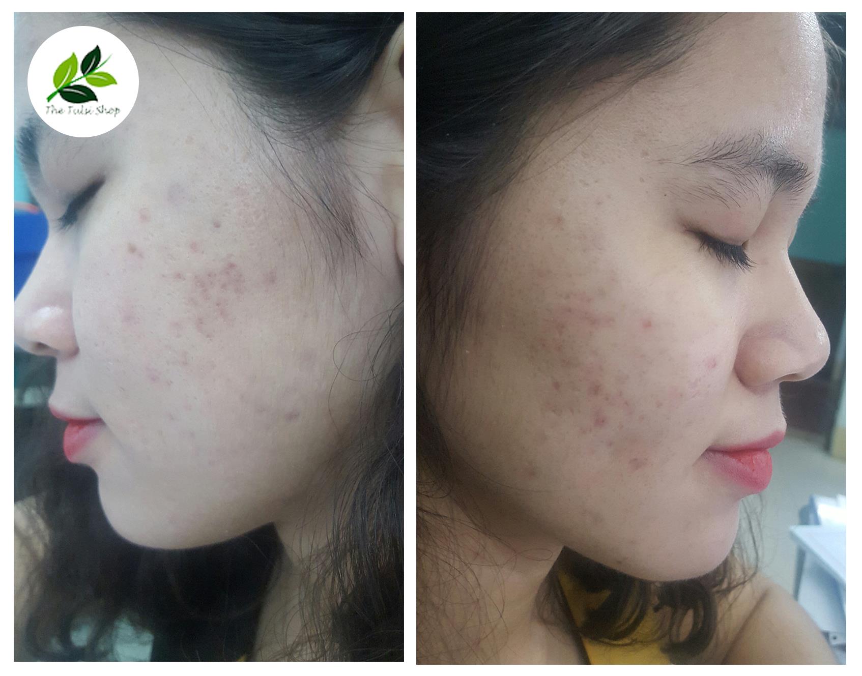 Nhật k&yacute; trị mụn gian nan của c&ocirc; g&aacute;i 24 tuổi - Ảnh 3.