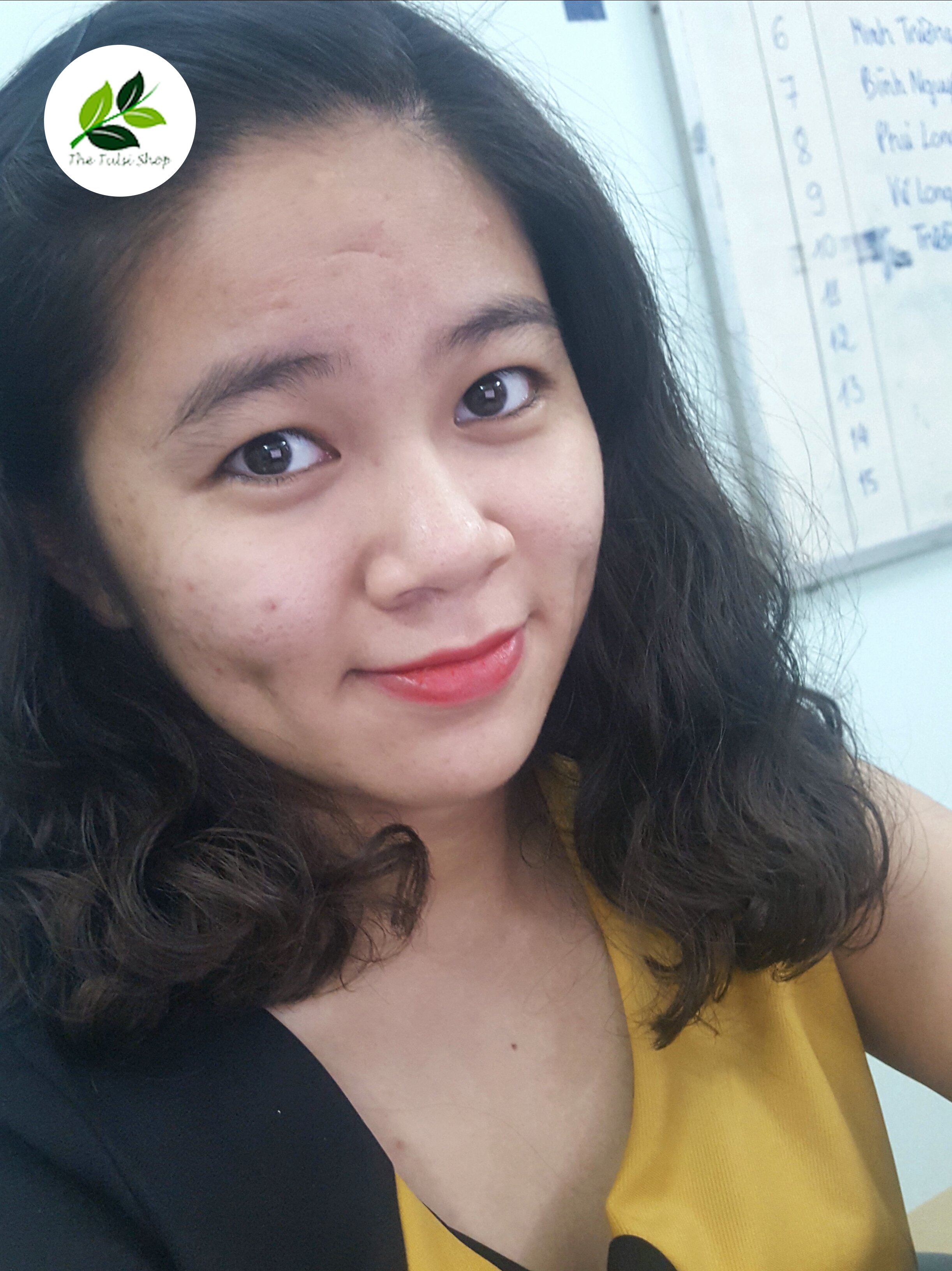 Nhật k&yacute; trị mụn gian nan của c&ocirc; g&aacute;i 24 tuổi - Ảnh 5.