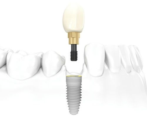 Tác dụng của phương pháp cấy ghép Implant với răng đã mất - Ảnh 1.
