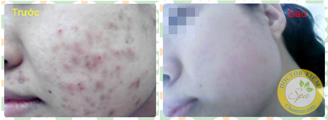 Hình ảnh trước và sau điều trị tại Doctor Kiệm Spa <span style="line-height: 1.6em;">của Khách hàng Dương Tuyết Nhung</span>