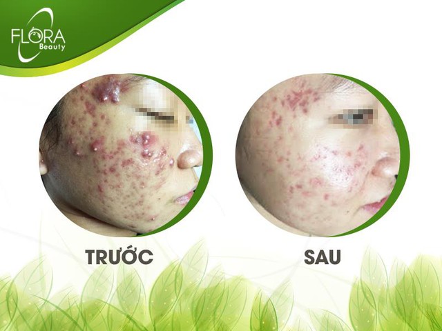 Bí quyết gạt đi nỗi lo da mụn mùa hè - Ảnh 4. Bí quyết gạt đi nỗi lo da mụn mùa hè - Ảnh 4.