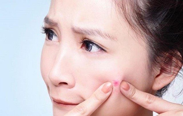 Tuyệt chi&ecirc;u đ&aacute;nh bay mụn vĩnh viện - Ảnh 1.