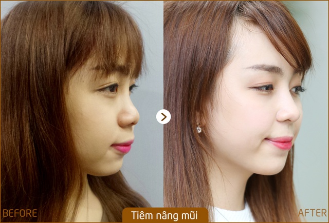 Tuyệt chiêu tạo mũi S-line cho người sợ đau - Ảnh 4.
