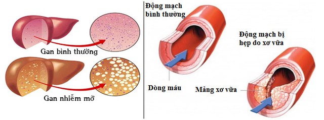 Mỡ máu cao dẫn đến nhiều bệnh nguy hiểm 1