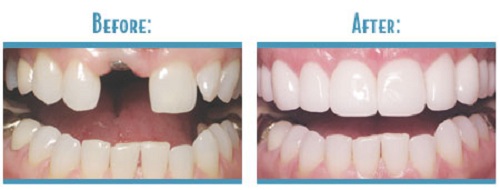 Quy trình cấy ghép răng giả như răng thật nhờ công nghệ mới - Ảnh 1.