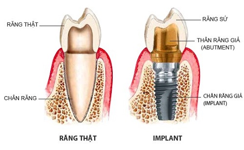 Quy trình cấy ghép răng giả như răng thật nhờ công nghệ mới - Ảnh 2.