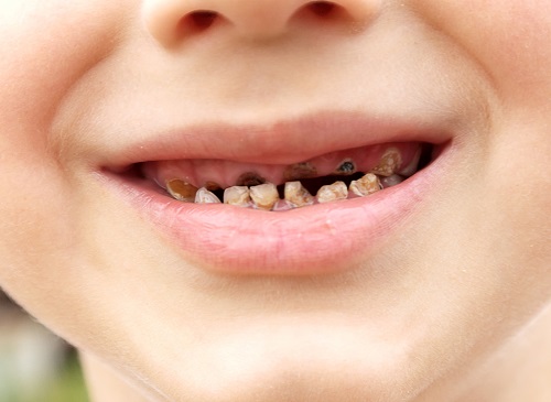 5 tác hại khôn lường nếu bé lười đánh răng mẹ Việt cần phải biết - Ảnh 4.