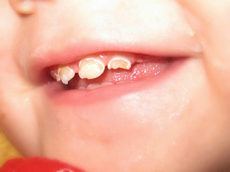 5 tác hại khôn lường nếu bé lười đánh răng mẹ Việt cần phải biết - Ảnh 6.