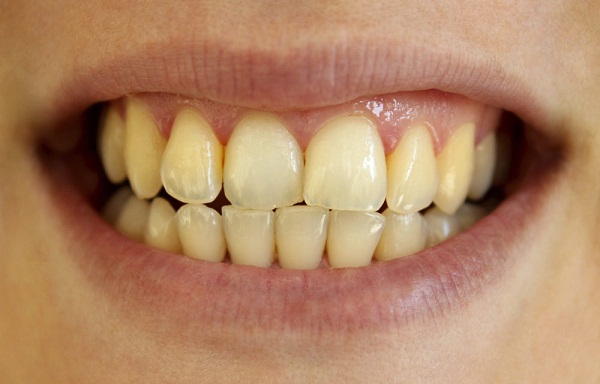 Loạt biến chứng nguy hiểm từ việc lười đánh răng - Ảnh 1.