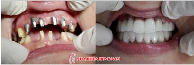 Công nghệ cấy ghép răng giả tự nhiên như răng thật - Ảnh 4.